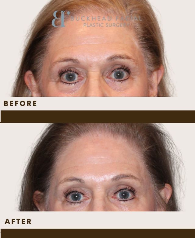 Lift & Brighten with Dysport! ✨

A subtle eyebrow lift can make a world of difference! 💉 Using Dysport, Dr. Jarmuz enhanced this patient’s natural beauty by lifting the brows for a more refreshed, youthful, and open-eyed look. 👁️✨

✔️ Softens forehead lines
✔️ Lifts & shapes the brows
✔️ Brightens & rejuvenates the eyes

Want to wake up looking more refreshed? Book your Dysport treatment today!

-

☎️ Call us at 404 233 3937.

-

-

-

#atlanta #atlmedspa #atlantamedspa #atlplasticsurgery #atlplasticsurgeon #atlantaplasticsurgery #atlantaplasticsurgeon